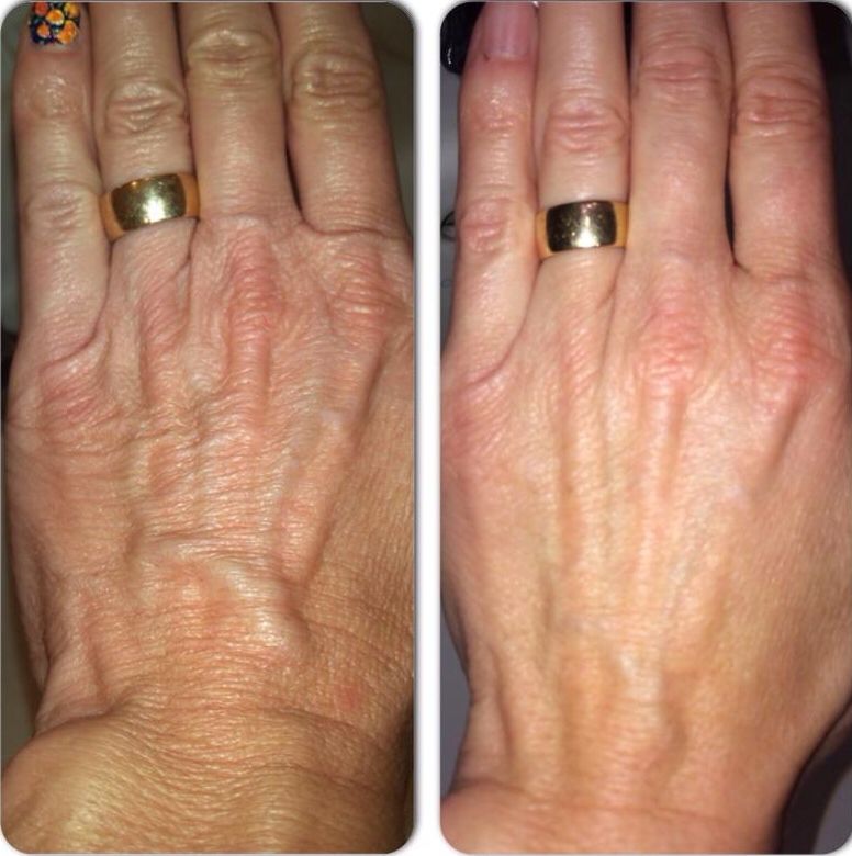 Before and after HandRestora results, Eileen, 66 · Limerick