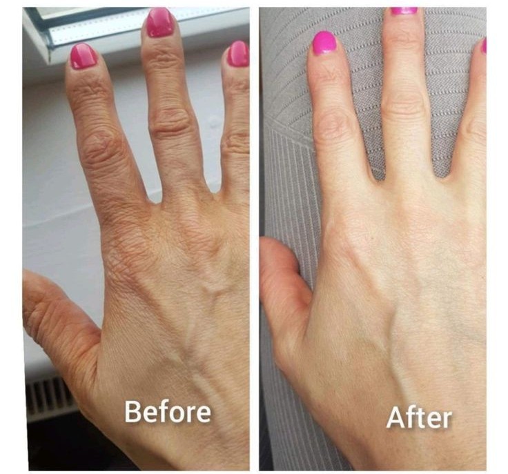 Before and after HandRestora results, Denise, 61 · Dublin