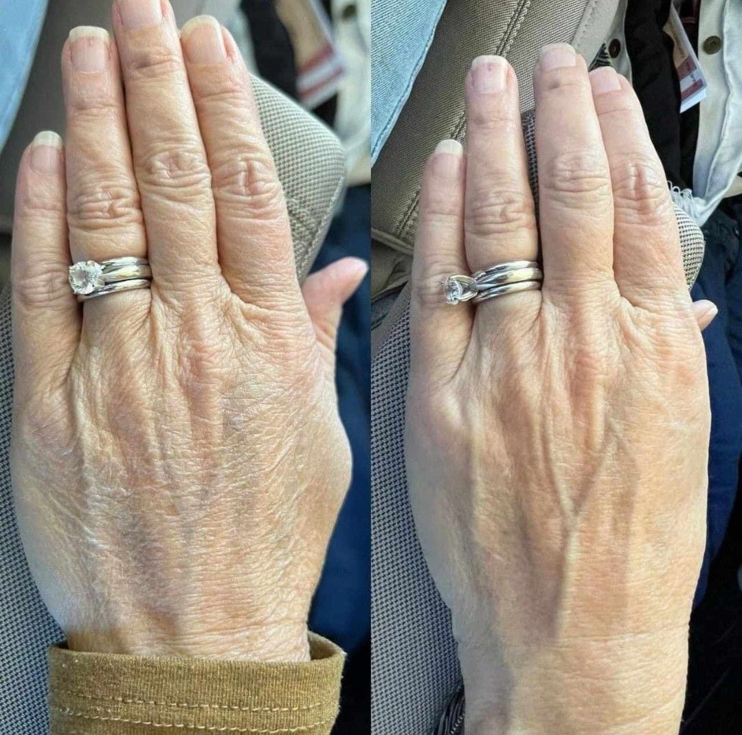 Before and after HandRestora results, Margaret, 68 · Cork