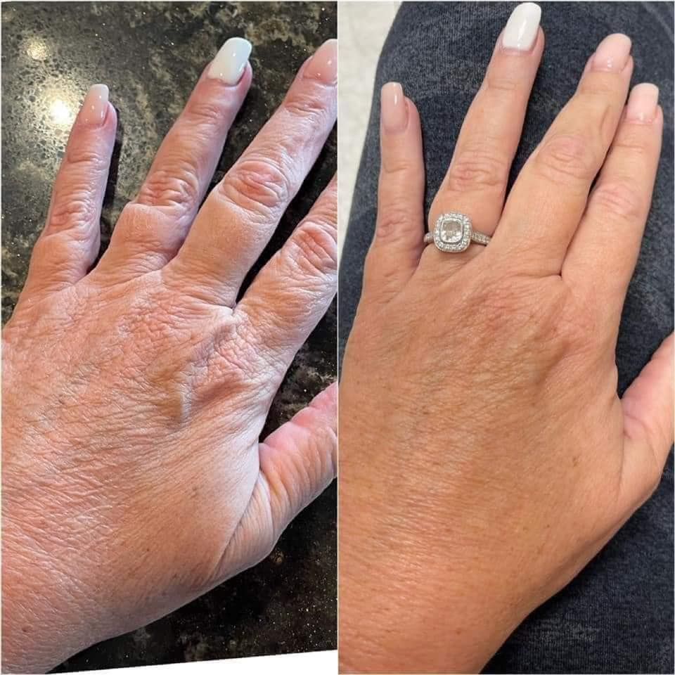Before and after HandRestora results, Helen, 58 · Galway